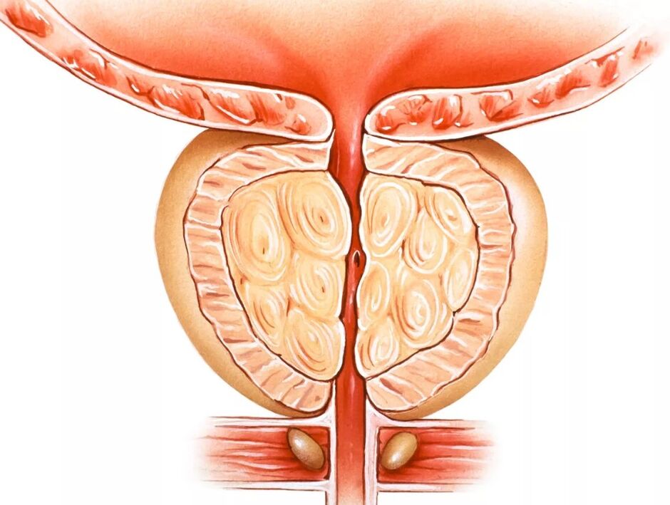 Prostatită