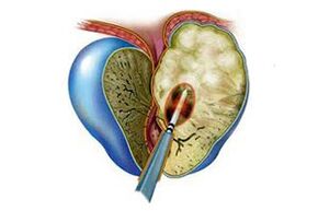 manifestare a prostatitei acute