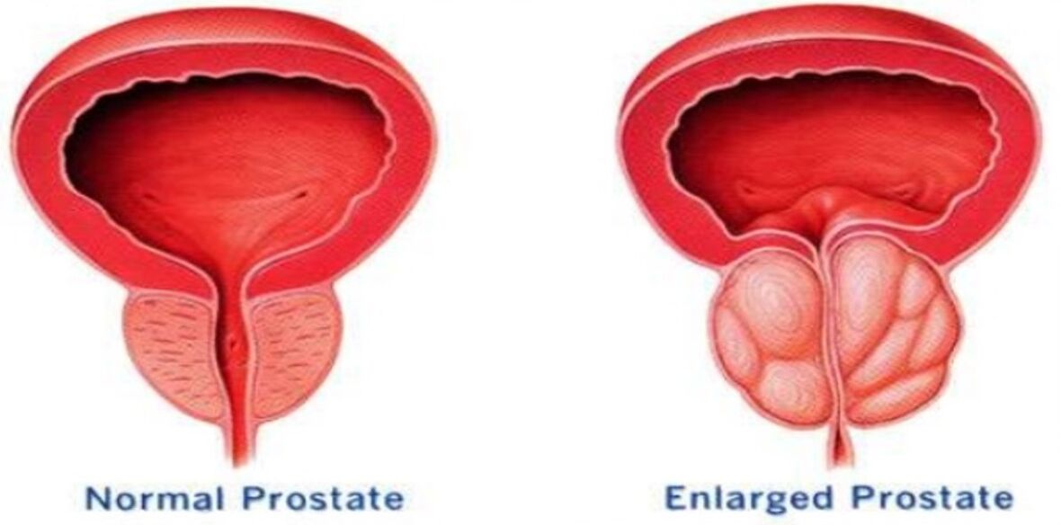 Prostată normală, prostată inflamată